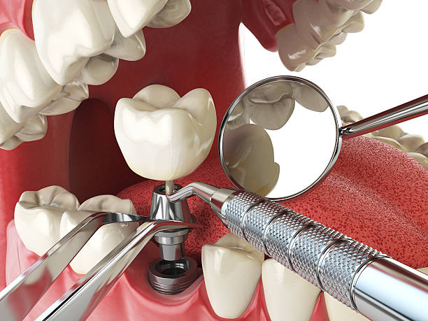 Best Emergency Dental Care for Broken or Chipped Teeth in Bear Creek, AL