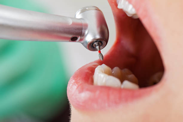 Best Emergency Treatment for Dental Infections or Abscesses in Bear Creek, AL